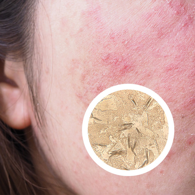 tre-acne-heal-step2